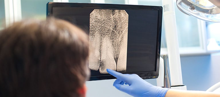 Dental Cavity on X-ray